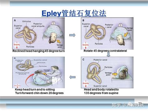 耳石復位法|临床常用 3 种耳石复位手法要点精析